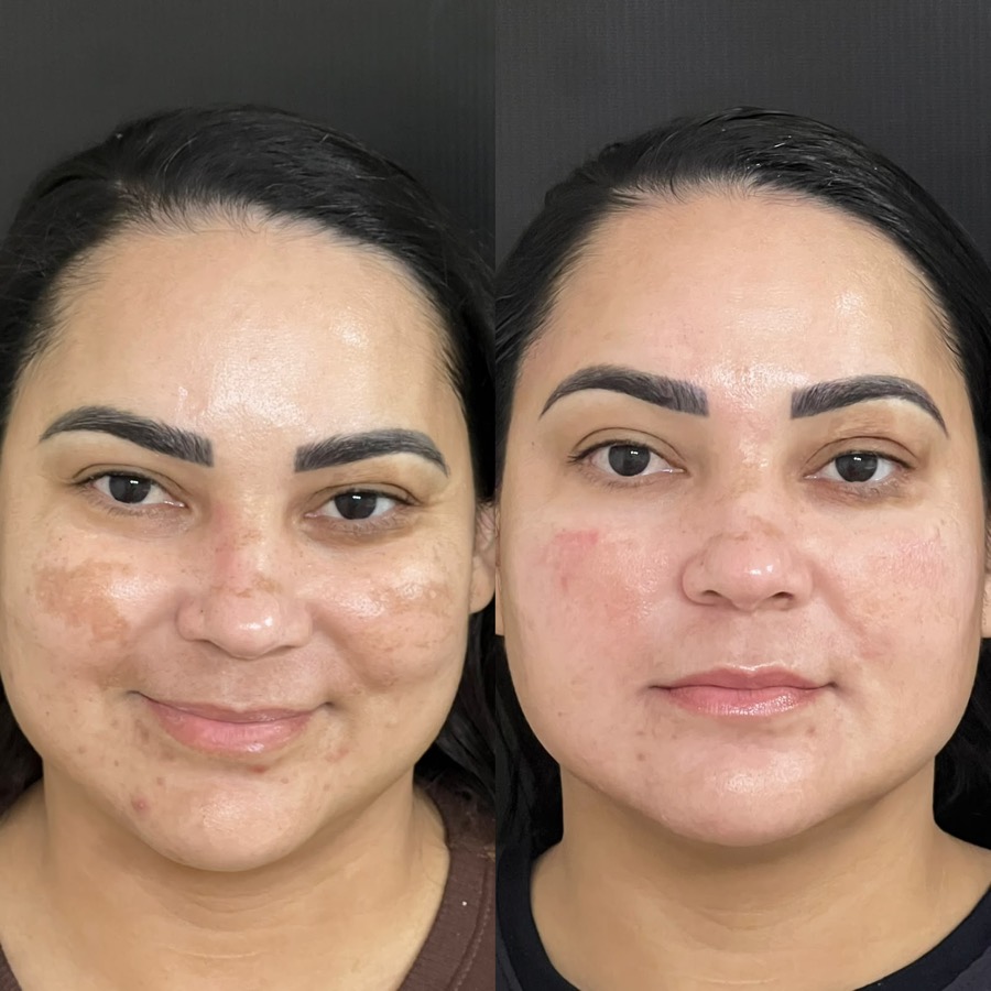 Antes e depois: manchas de melasma nas maçãs do rosto bem mais claras
