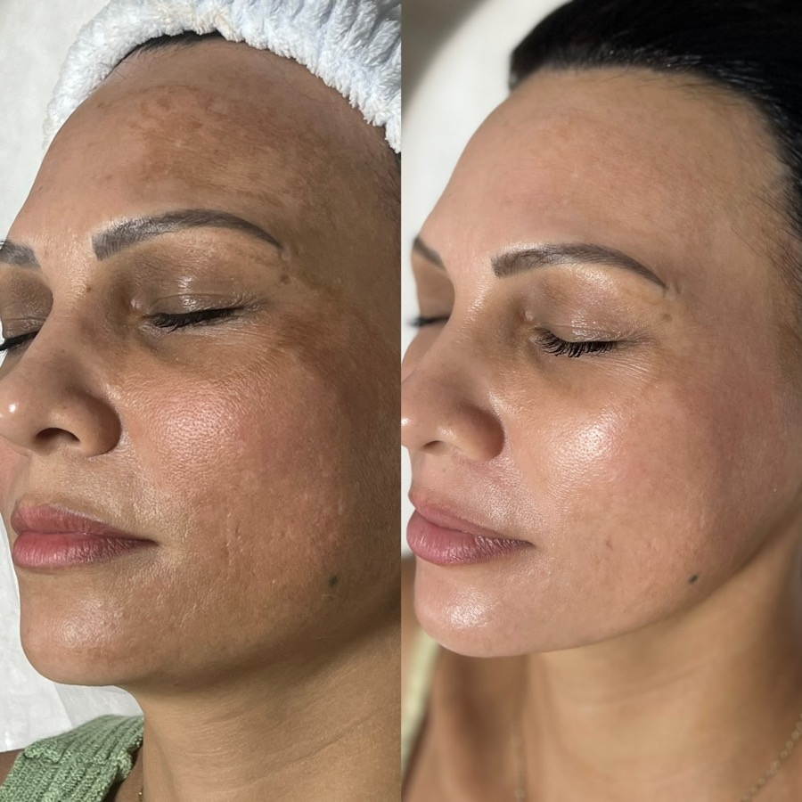 Antes e depois: melasma na testa e na bochecha, visto de lado, com a pele mais uniforme