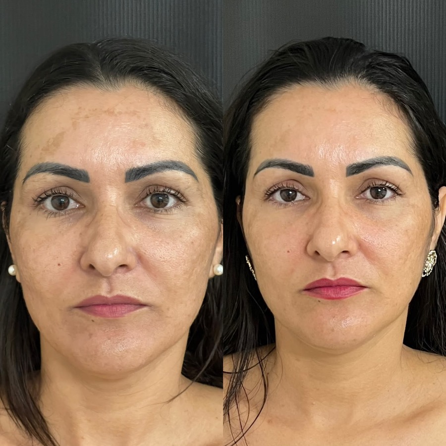 Antes e depois: manchas na testa e nas bochechas mais claras